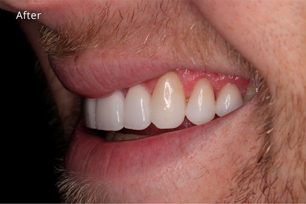 After Cosmetic Dentistry