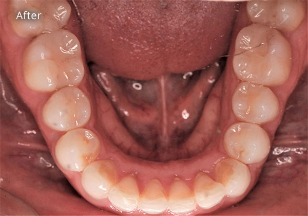 After Cosmetic Dentistry