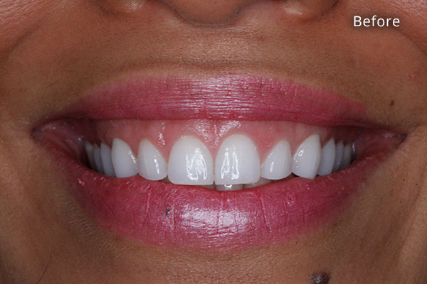 Before Cosmetic Dentistry