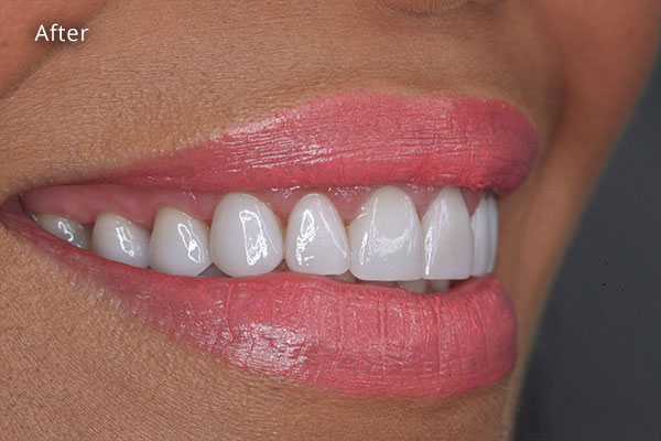 After Cosmetic Dentistry