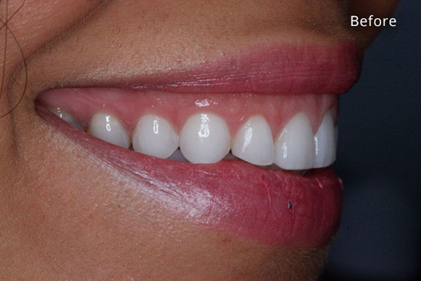 Before Cosmetic Dentistry