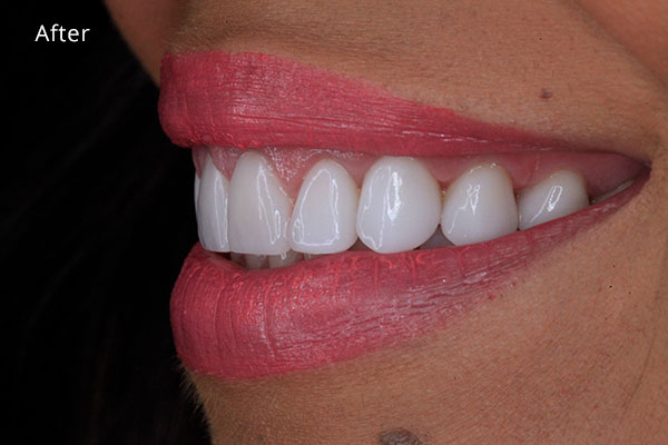 After Cosmetic Dentistry