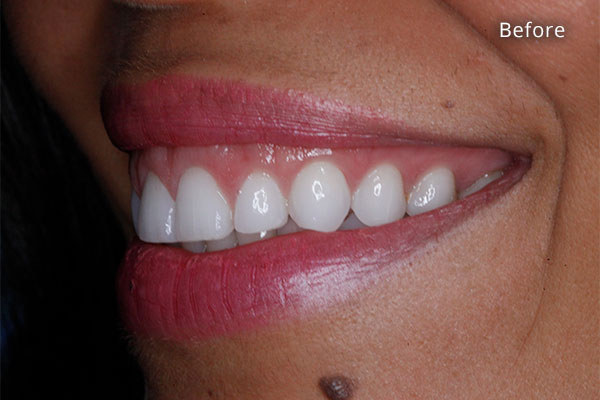 Before Cosmetic Dentistry