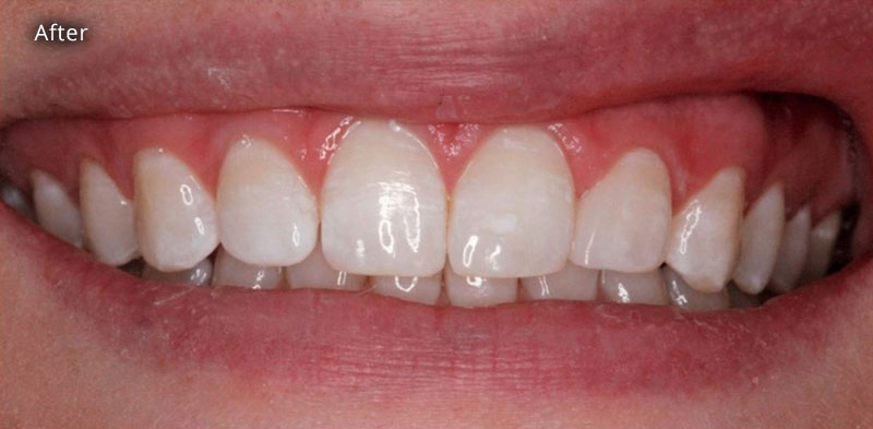 After Cosmetic Dentistry