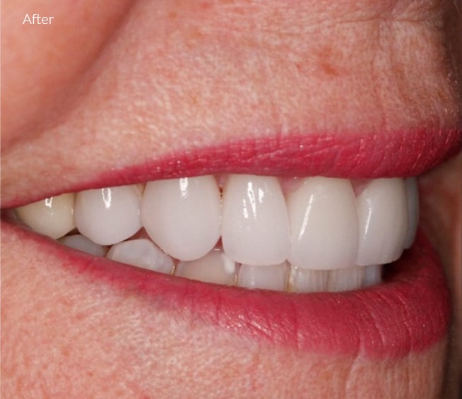 After Cosmetic Dentistry