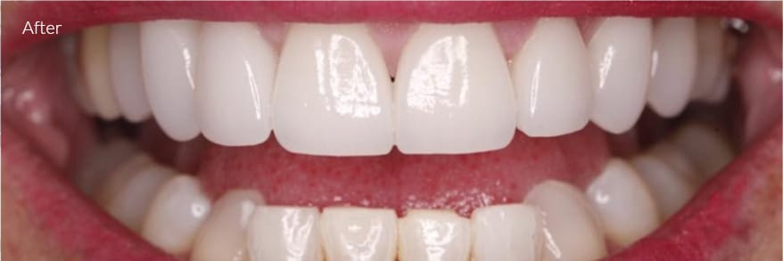 After Cosmetic Dentistry