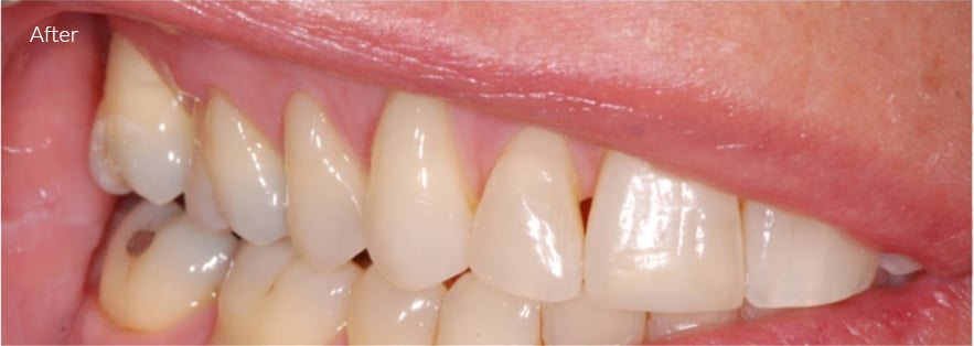 After Cosmetic Dentistry