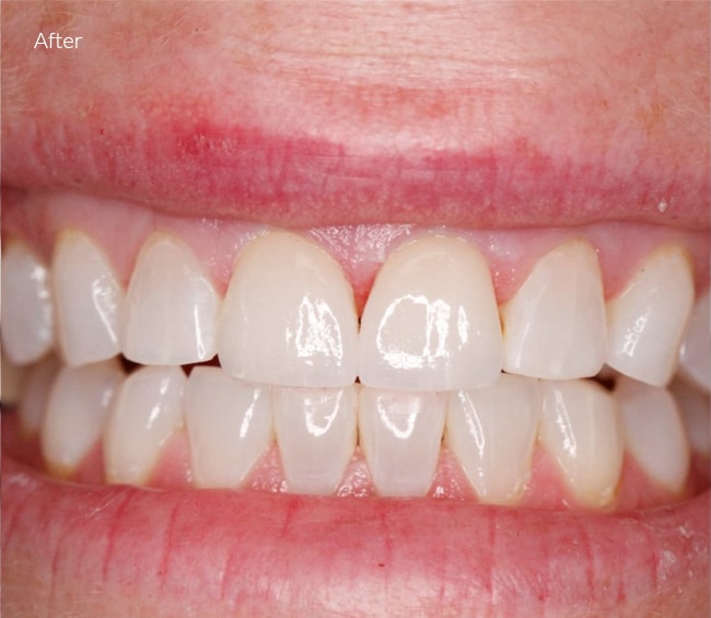 After Cosmetic Dentistry