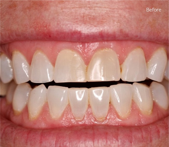 Before Cosmetic Dentistry