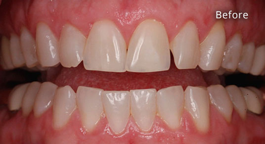 Before Cosmetic Dentistry