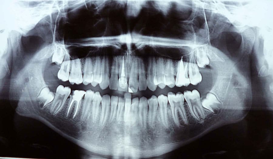 Implant Prep Carmel Indiana