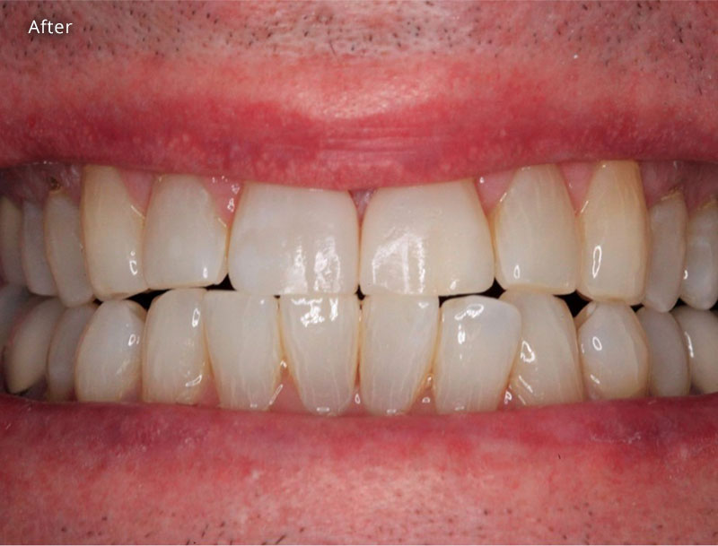 After Cosmetic Dentistry