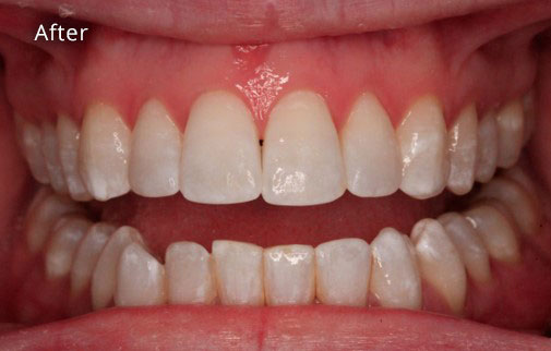 After Cosmetic Dentistry