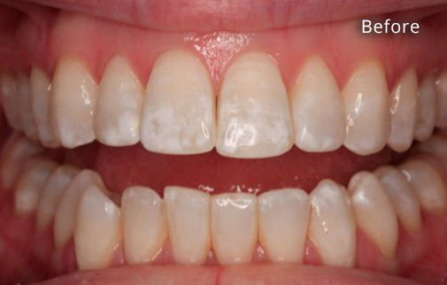 Before Cosmetic Dentistry