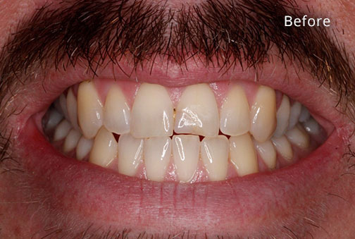 Before Cosmetic Dentistry