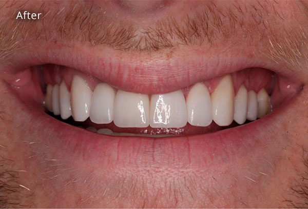 After Cosmetic Dentistry