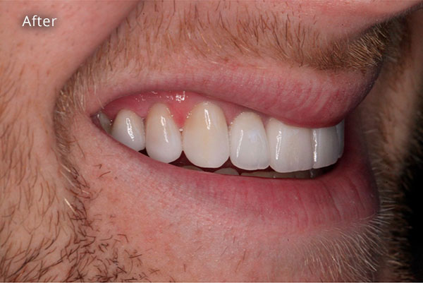 After Cosmetic Dentistry