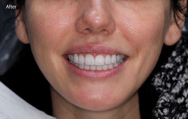 After Cosmetic Dentistry