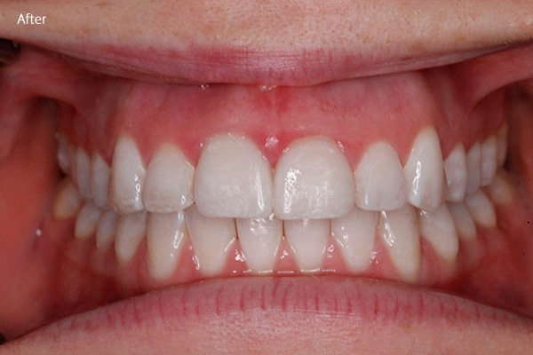 After Cosmetic Dentistry