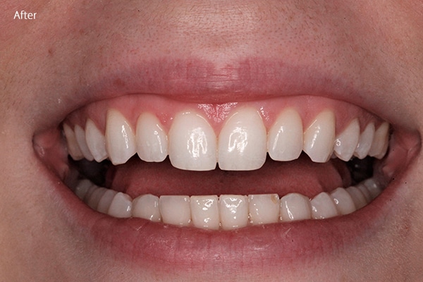 After Cosmetic Dentistry