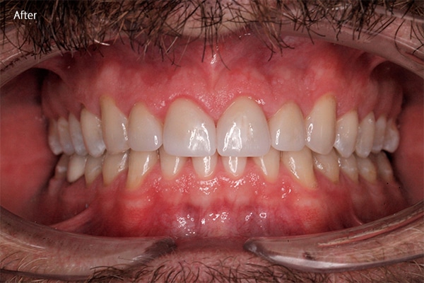 After Cosmetic Dentistry