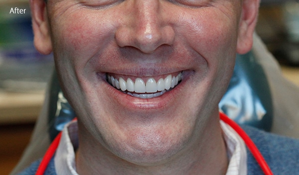 After Cosmetic Dentistry