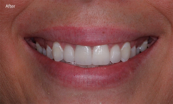 After Cosmetic Dentistry