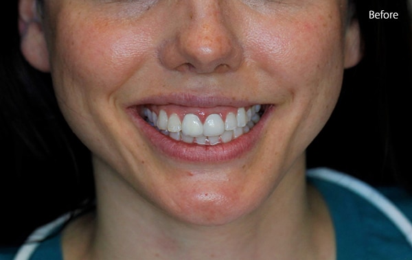 Before Cosmetic Dentistry