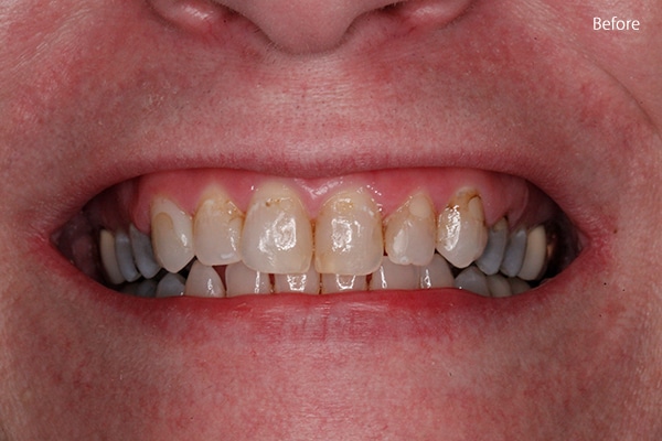 Before Cosmetic Dentistry