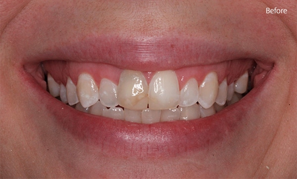 Before Cosmetic Dentistry