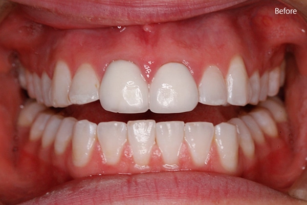 Before Cosmetic Dentistry