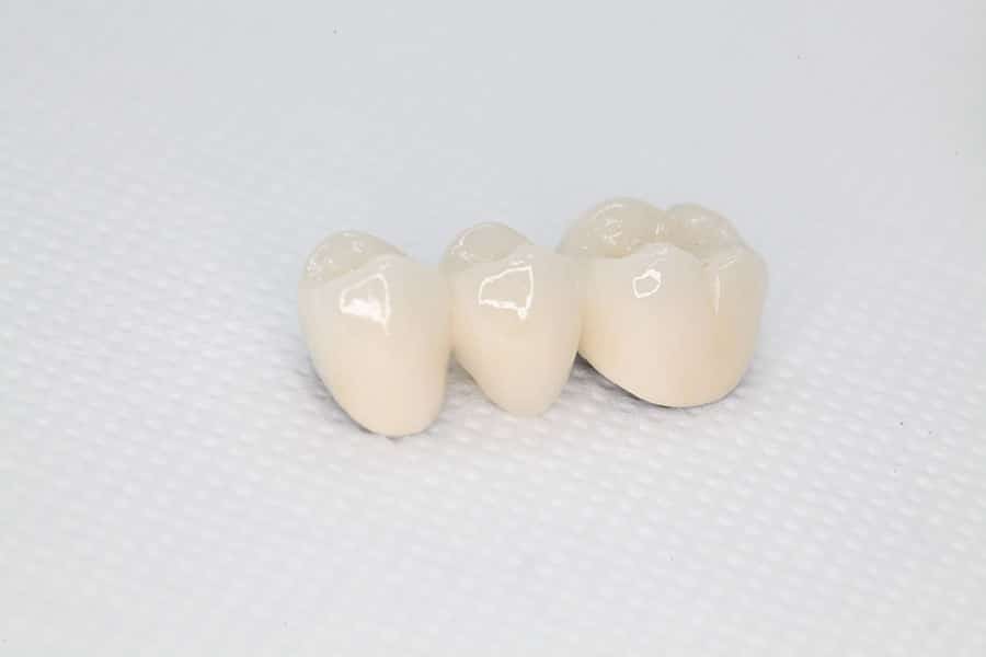 Tooth Bridges and Crowns Carmel IN
