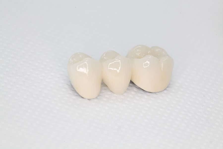 Tooth Bridges and Crowns Carmel IN