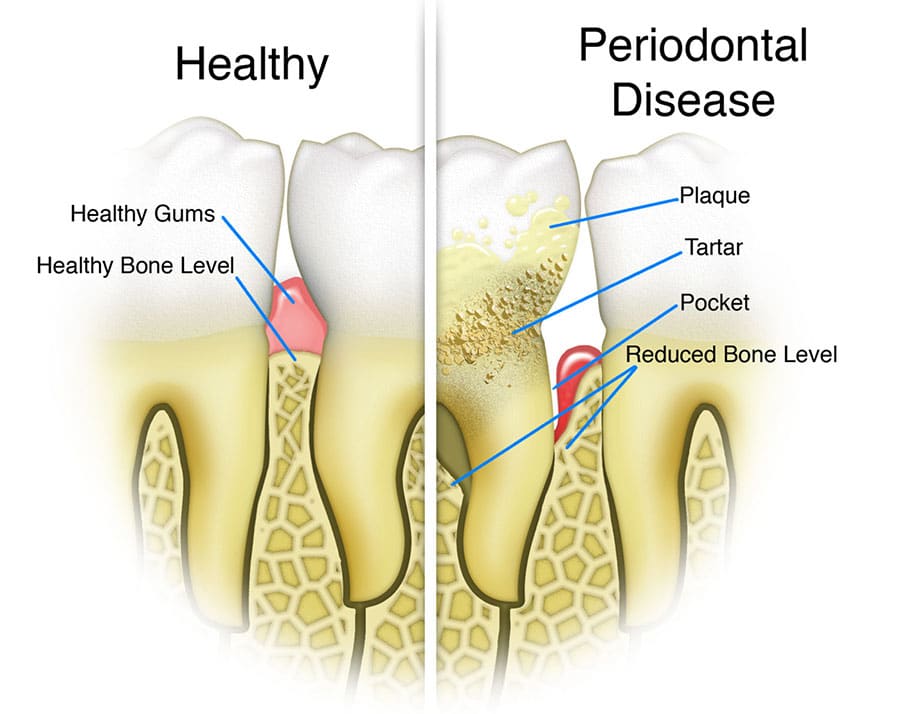 Correct Periodontitis Carmel Indiana