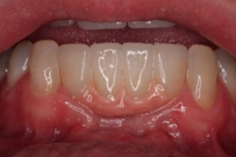 After Cosmetic Dentistry