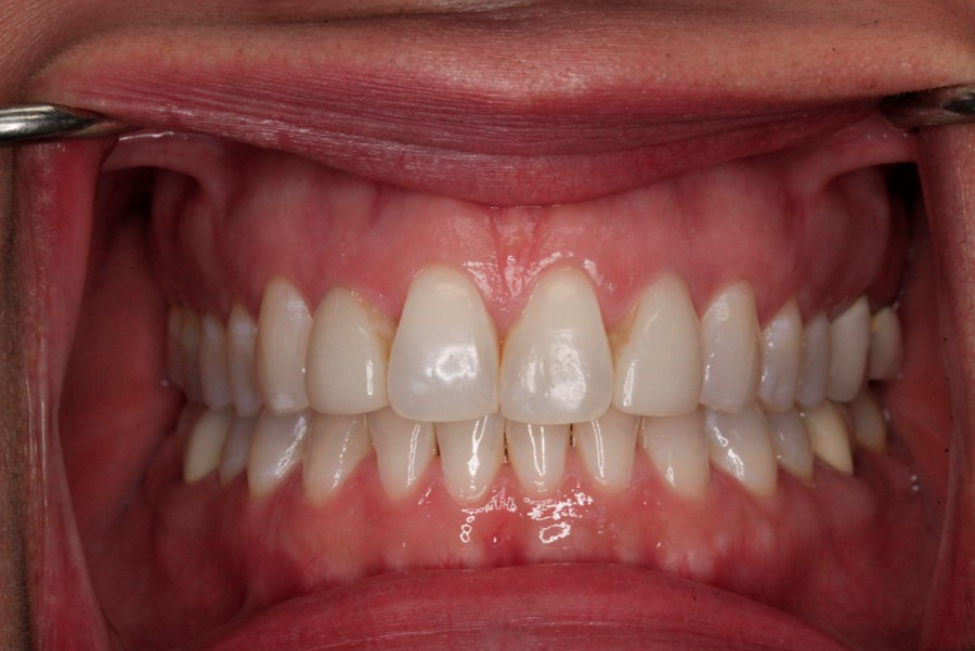 Before Cosmetic Dentistry