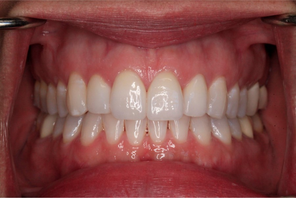 After Cosmetic Dentistry