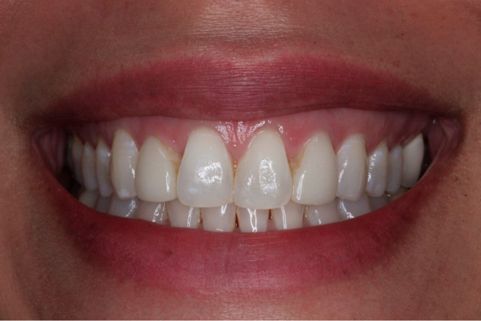 Before Cosmetic Dentistry