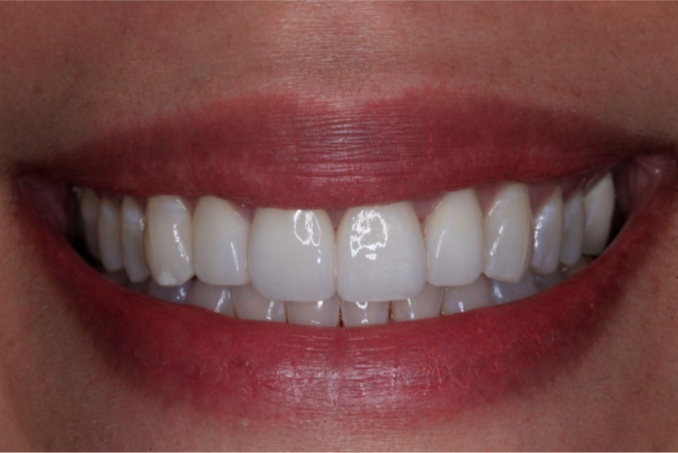 After Cosmetic Dentistry