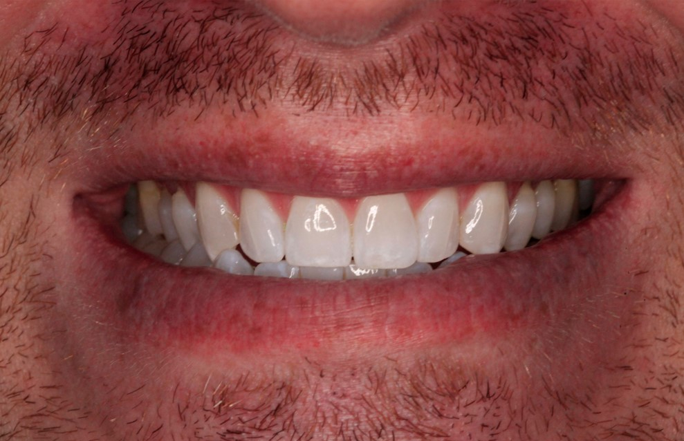 Before Cosmetic Dentistry