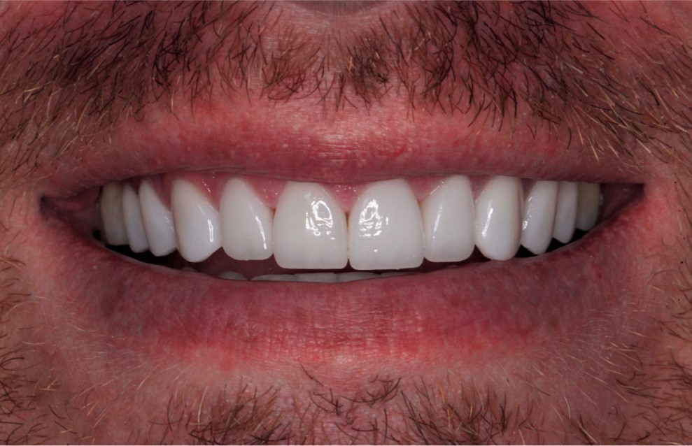 After Cosmetic Dentistry