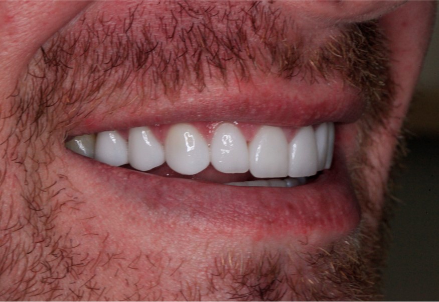 After Cosmetic Dentistry