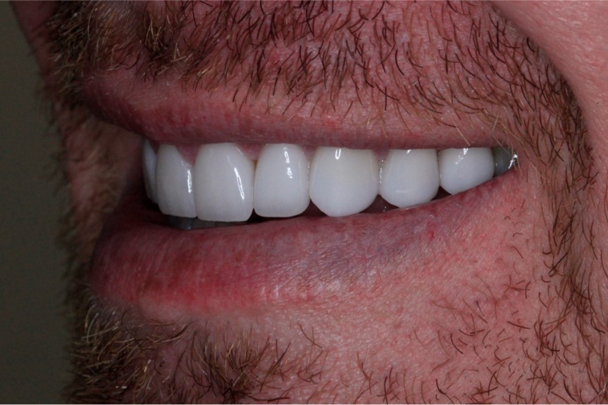 After Cosmetic Dentistry