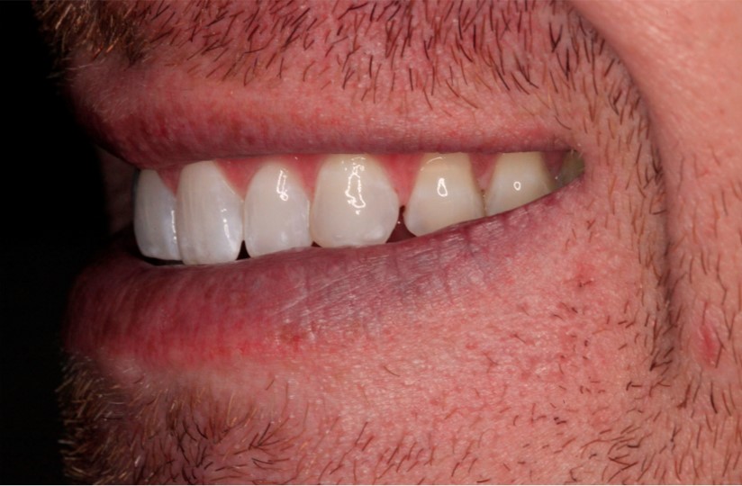 Before Cosmetic Dentistry