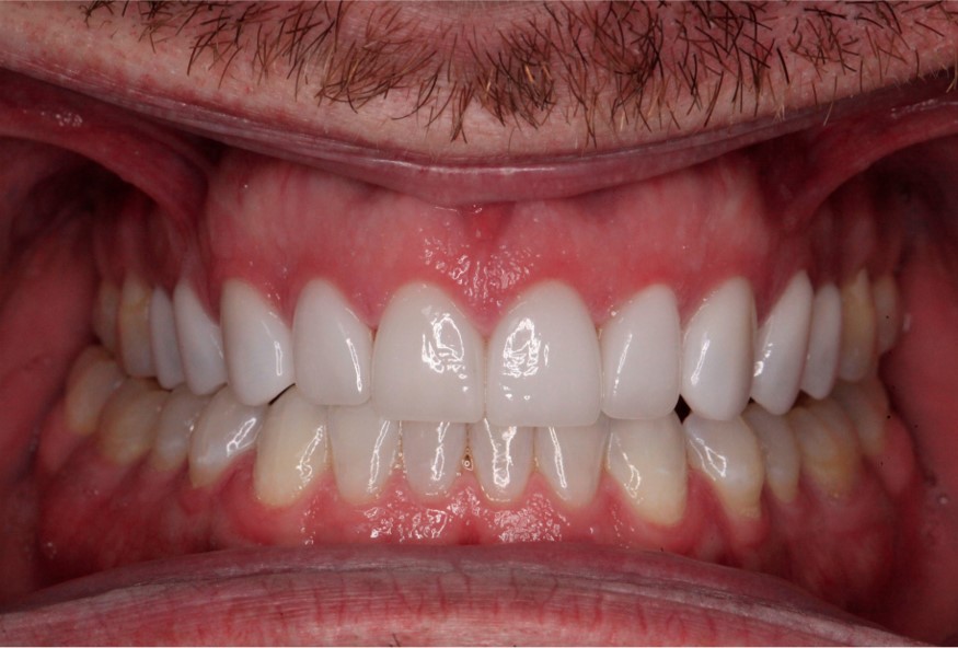 After Cosmetic Dentistry