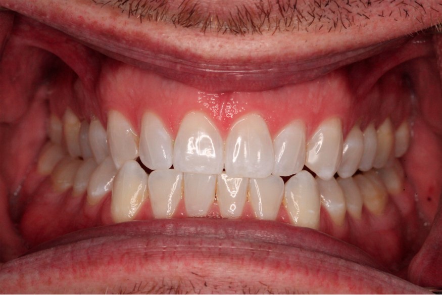 Before Cosmetic Dentistry