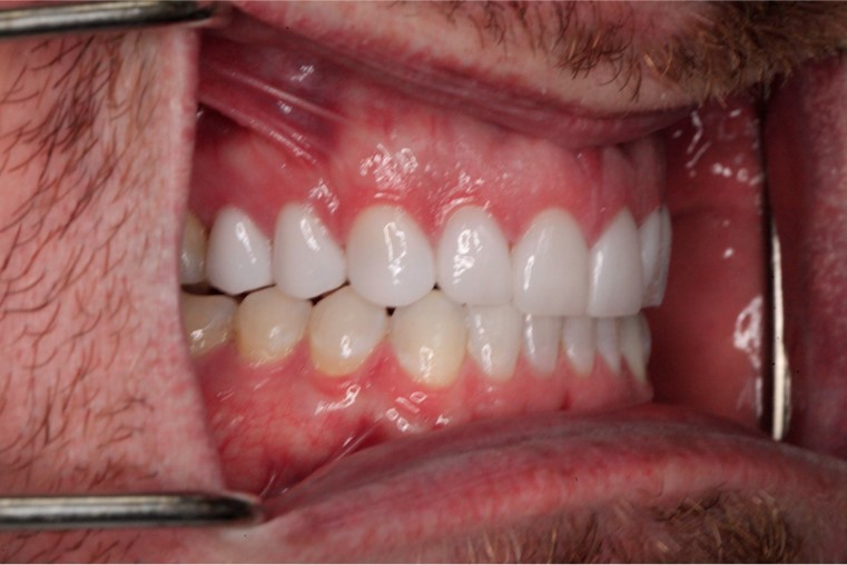 After Cosmetic Dentistry