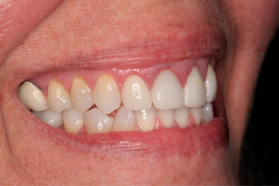 Before Cosmetic Dentistry