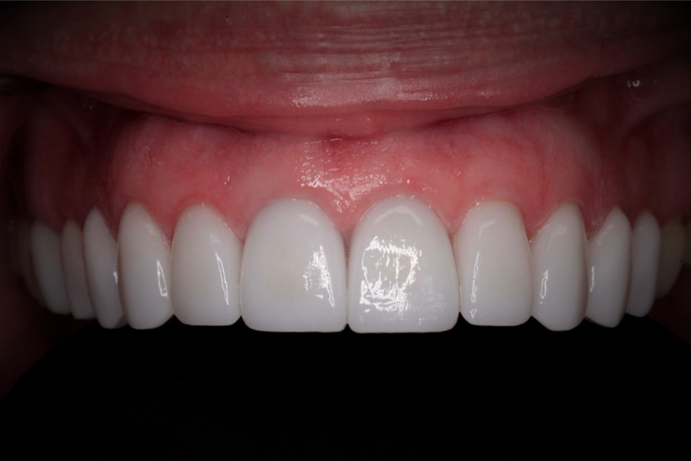 After Cosmetic Dentistry