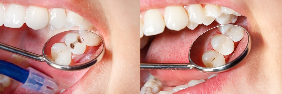 Cavity Fillings 101
